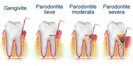 foto-gengivite-e-parodontite