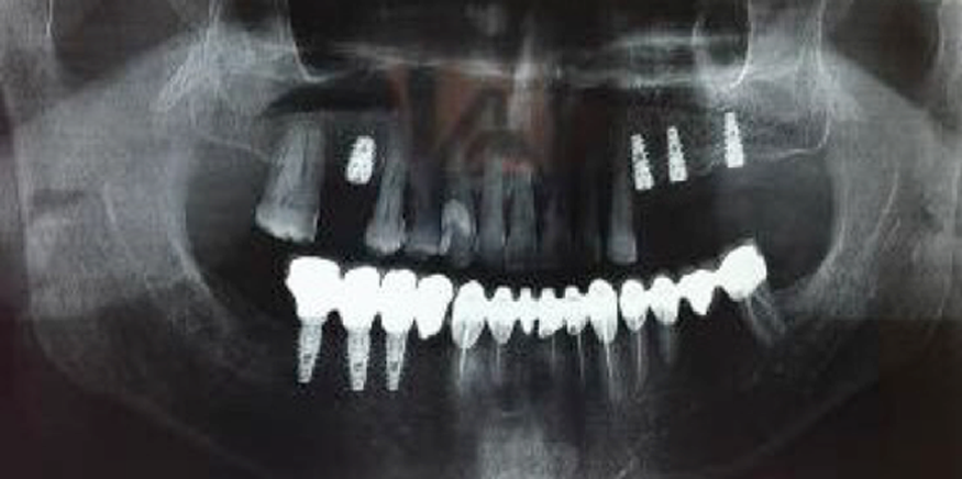 impianto-dentale
