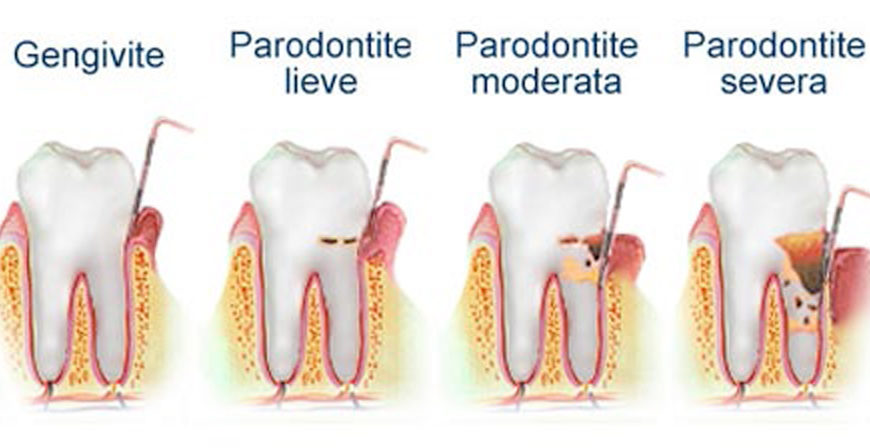 Gengivite e parodontite
