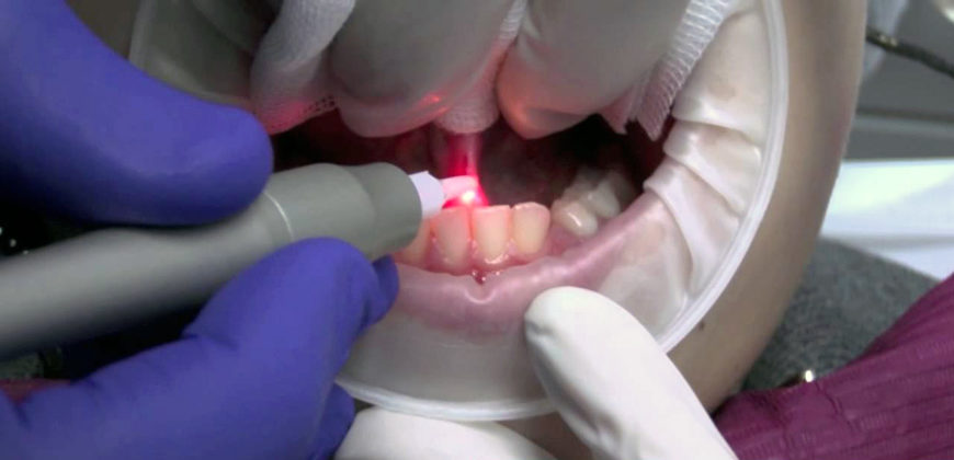 Piccola chirurgia laser