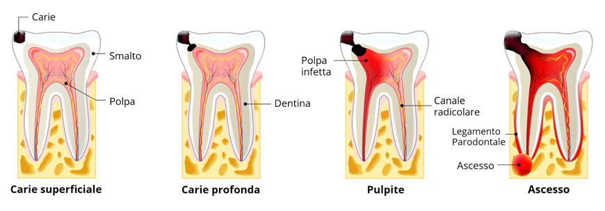 Endodonzia (devitalizzazzione e ritrattamenti canalari)